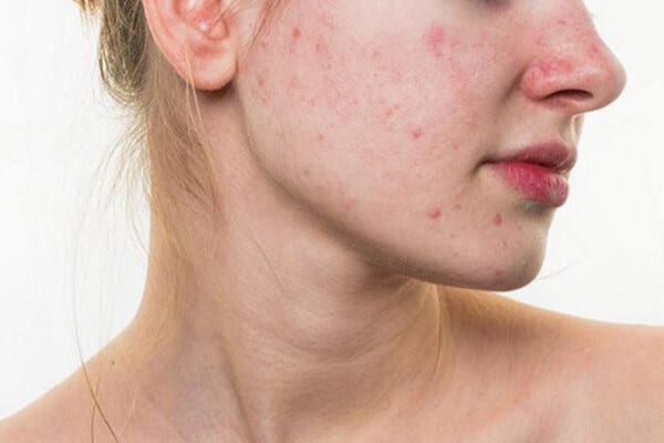 Cách đắp mặt nạ tinh bột nghệ để trẻ đẹp chỉ trong 2 tuần - Ảnh 3