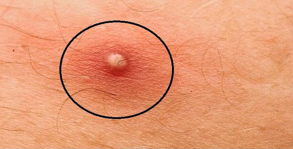 Mẹo chữa mụn nhọt đơn giản có thể bạn chưa biết